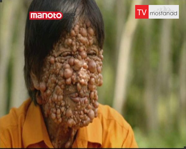 دانلود مستند مرد پوست حبابی از مجموعه انسان های شگفت اور دانلود مستند مرد پوست حبابی از مجموعه انسان های شگفت اور