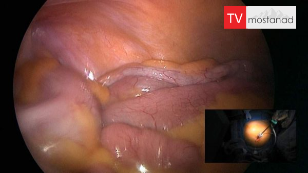 Operation Tumor removal دانلود مستند برداشتن تومور از مجموعه اتاق عمل با دوبله شبکه منوتو